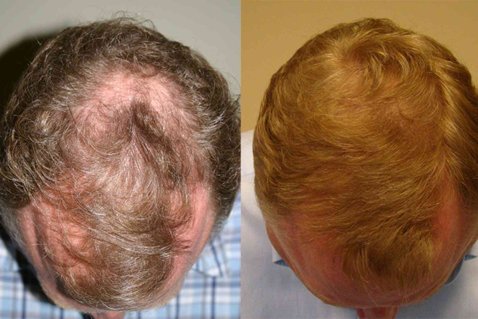 Hair Transplant Turkey